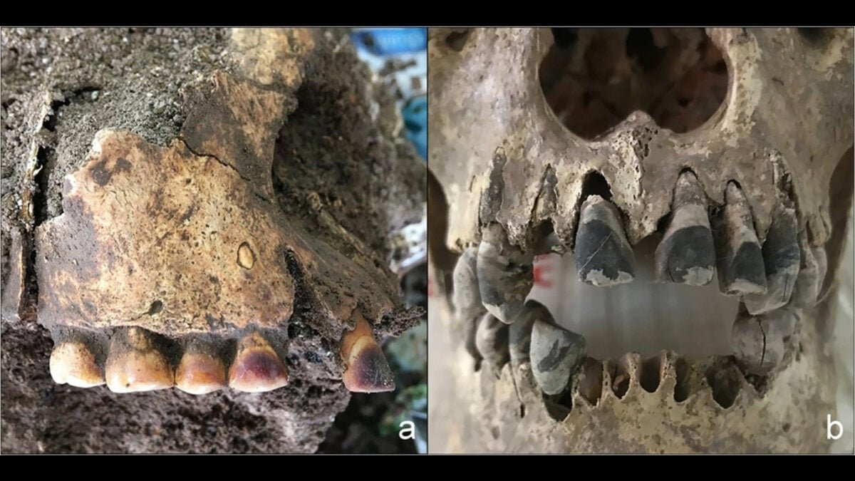 vietname dong xa tooth blackening skeleton