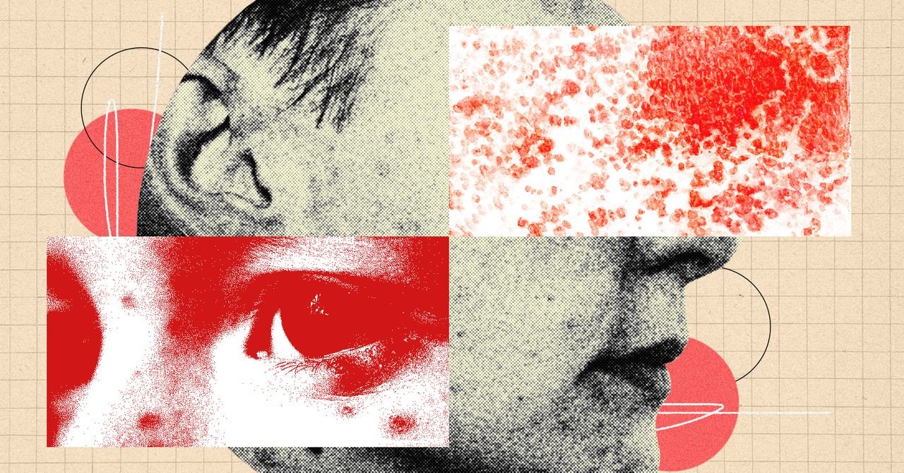 Shingles Series Why Shingles Is Bigger Deal Than You Think Science