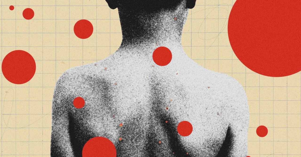 Shingles Series Chickenpox Parties Science