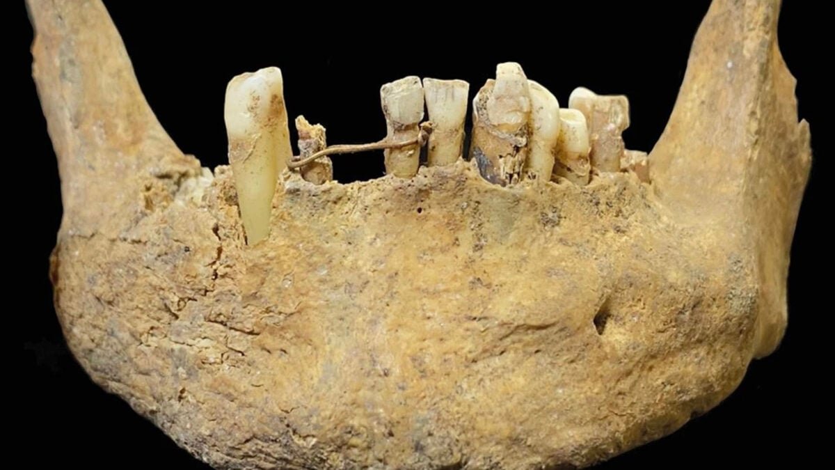 gold ligature medieval dentistry